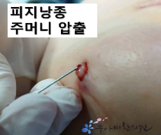 치료 후