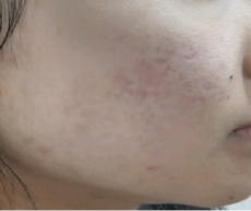 치료 후