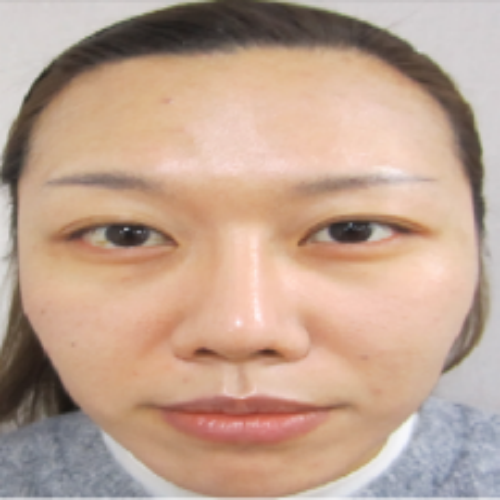 치료 후
