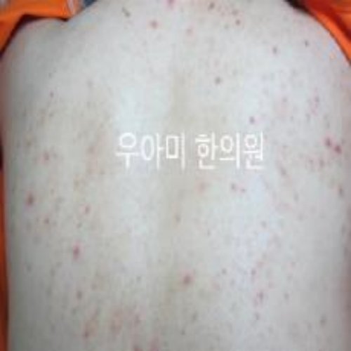 치료 전