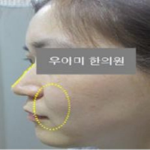 치료 전