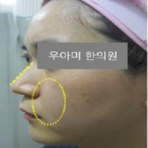 치료 후