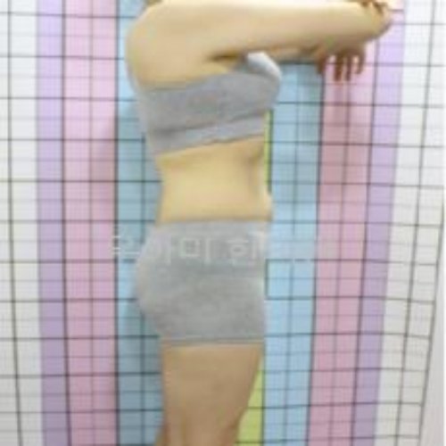 치료 후
