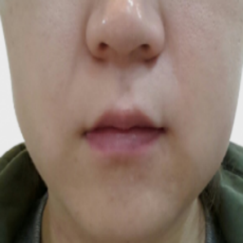 치료 전