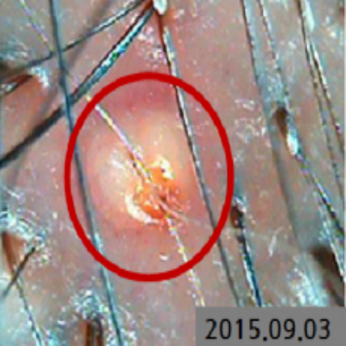 치료 전