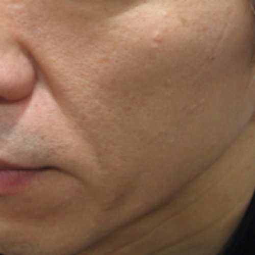치료 후