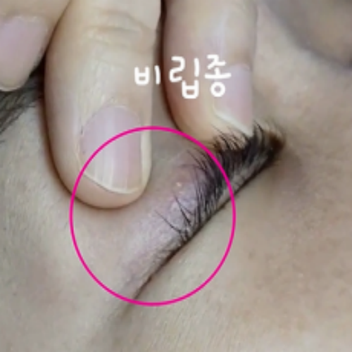 치료 전