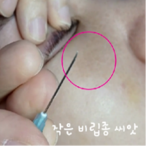 치료 후