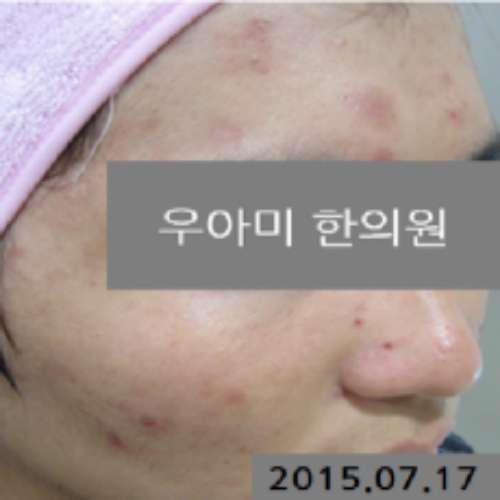치료 전