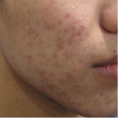 치료 전