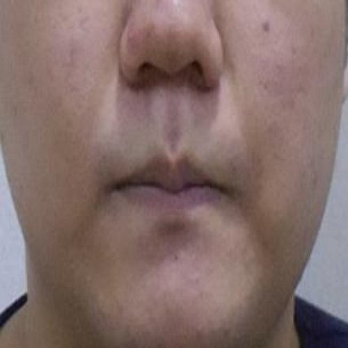 치료 후