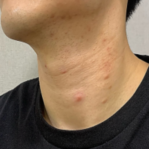 치료 전