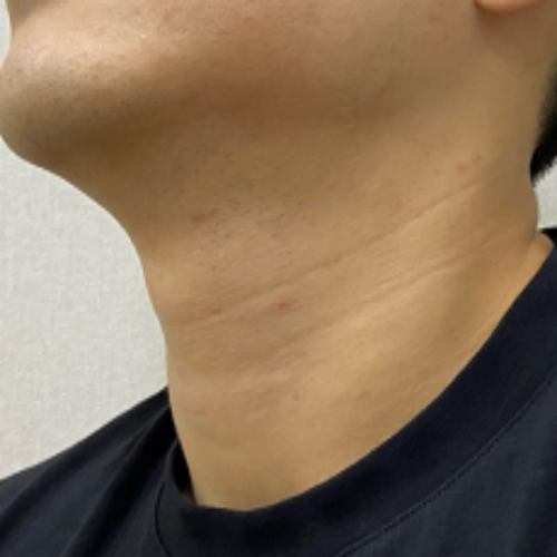 치료 후