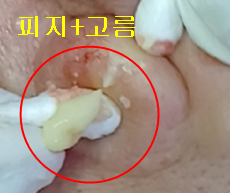 치료 전