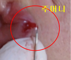 치료 후