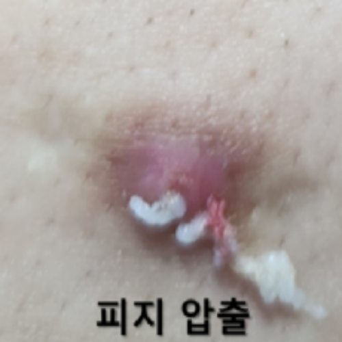 치료 전
