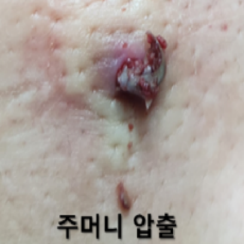 치료 후