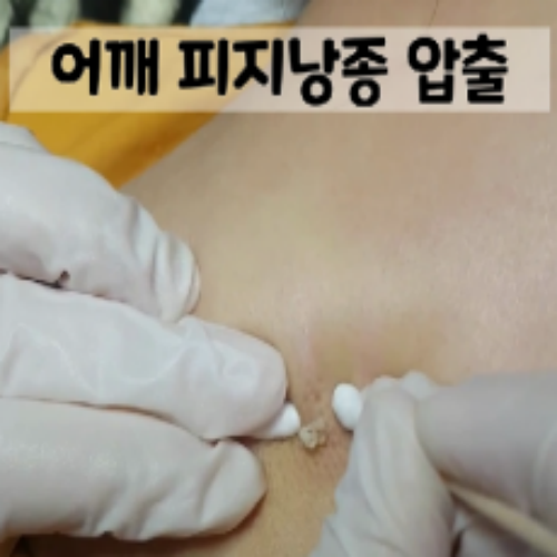치료 전