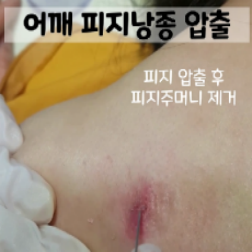 치료 후