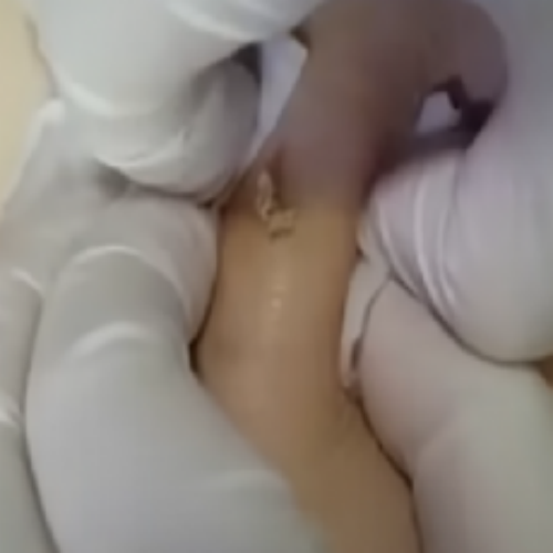 치료 전