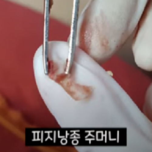 치료 후