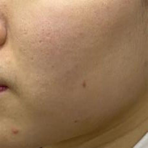 치료 후