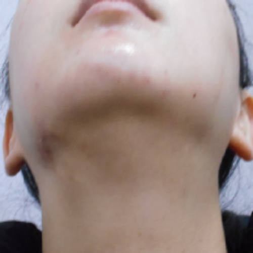 치료 후
