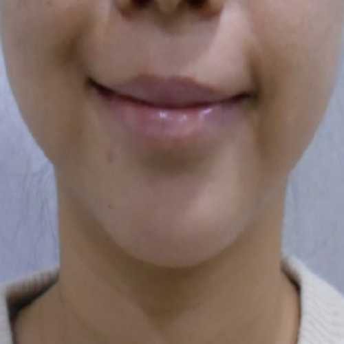 치료 전