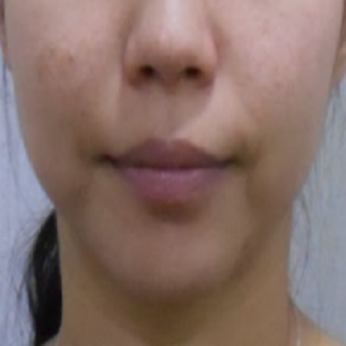 치료 후