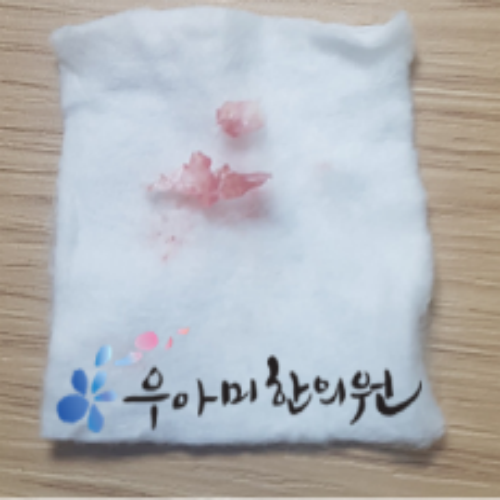 치료 후