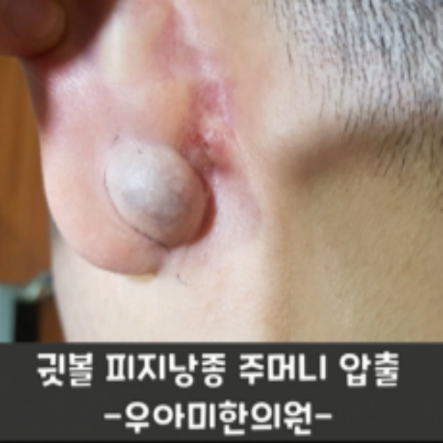 치료 전