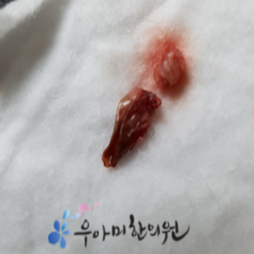 치료 후