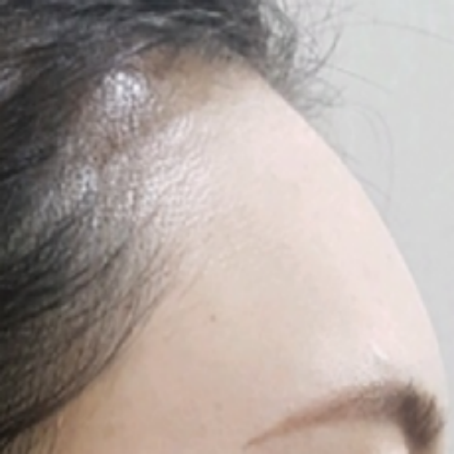 치료 후