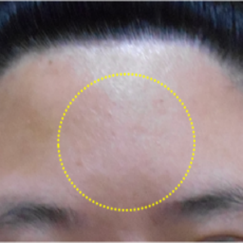 치료 후