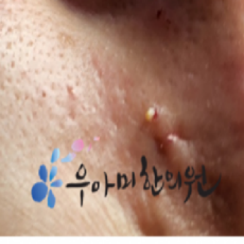 치료 후