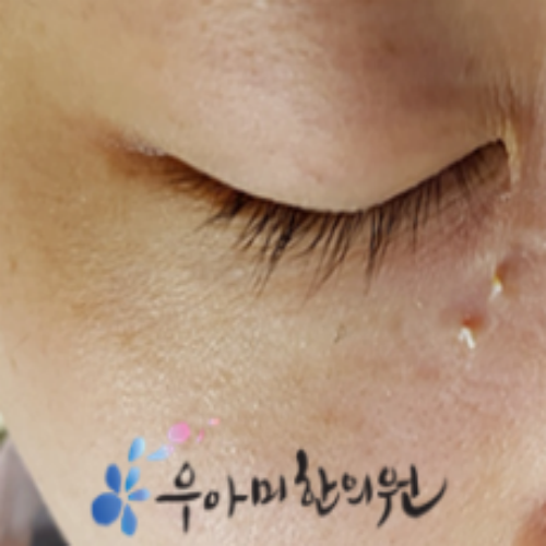 치료 후