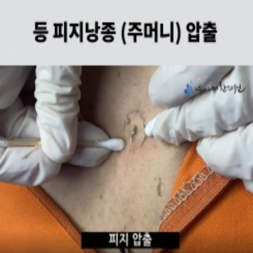 치료 전