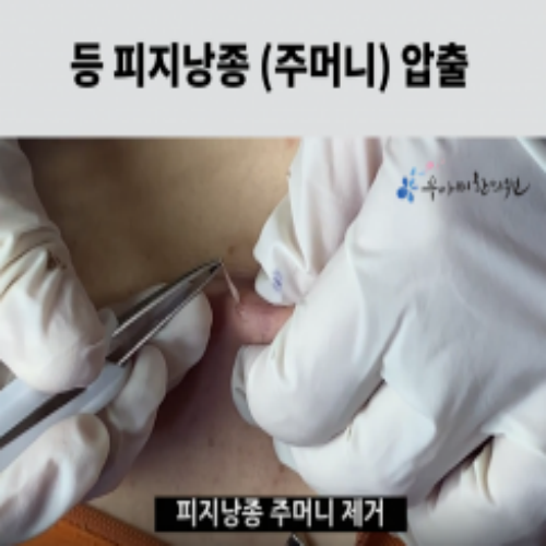 치료 후