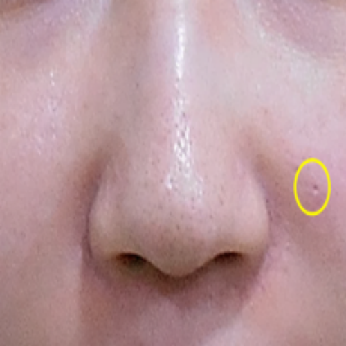 치료 전