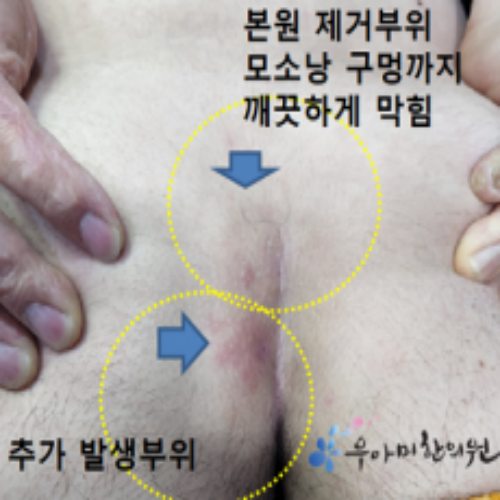 치료 후