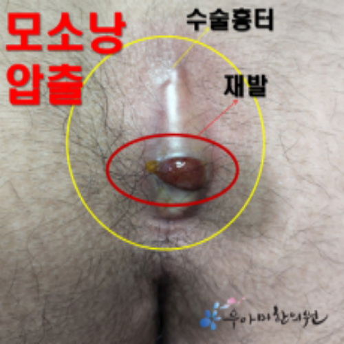 치료 전