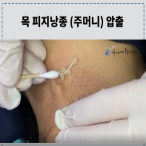 치료 전