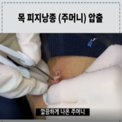치료 후