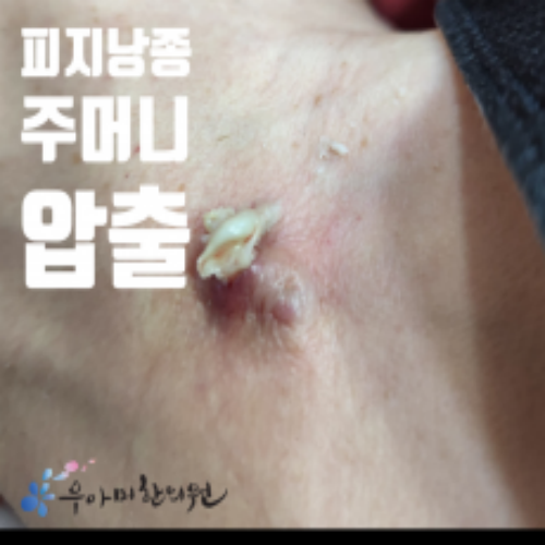 치료 후