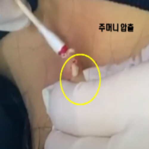 치료 후
