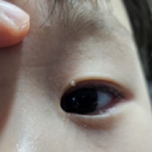 치료 전