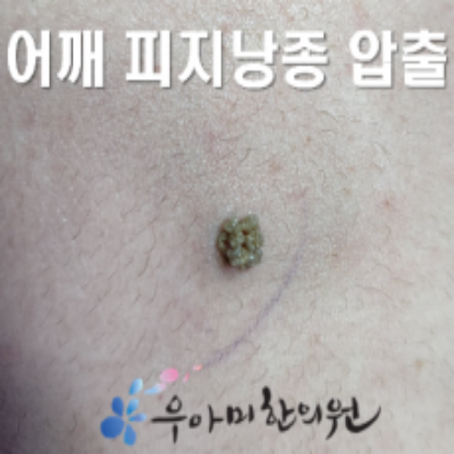 치료 전