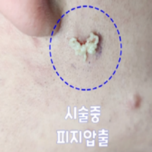치료 전