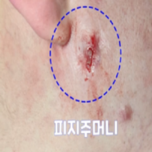 치료 후