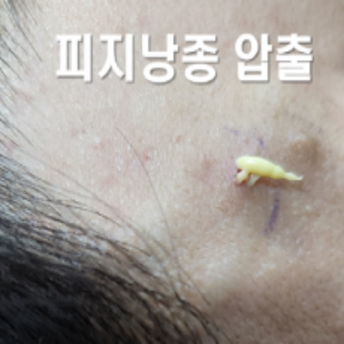 치료 전